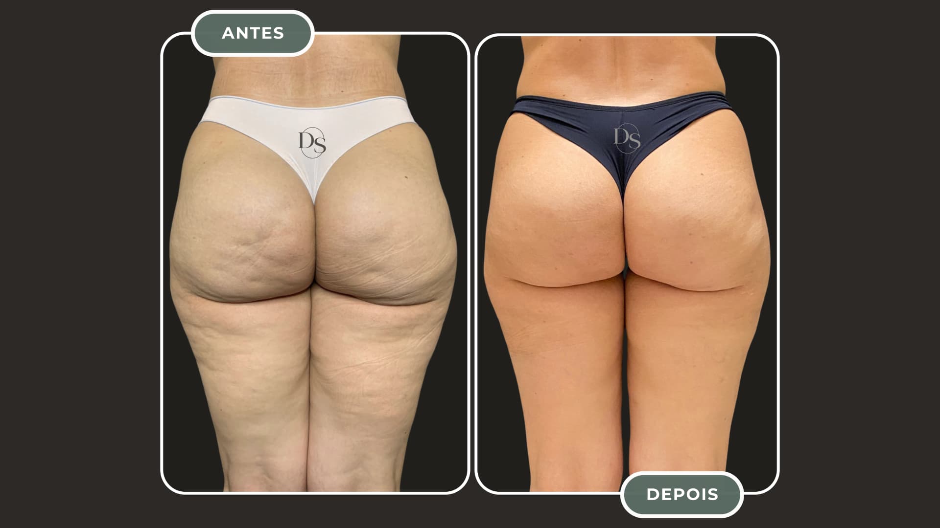 Antes e depois do tratamento de celulite — glúteos e posterior de coxas
