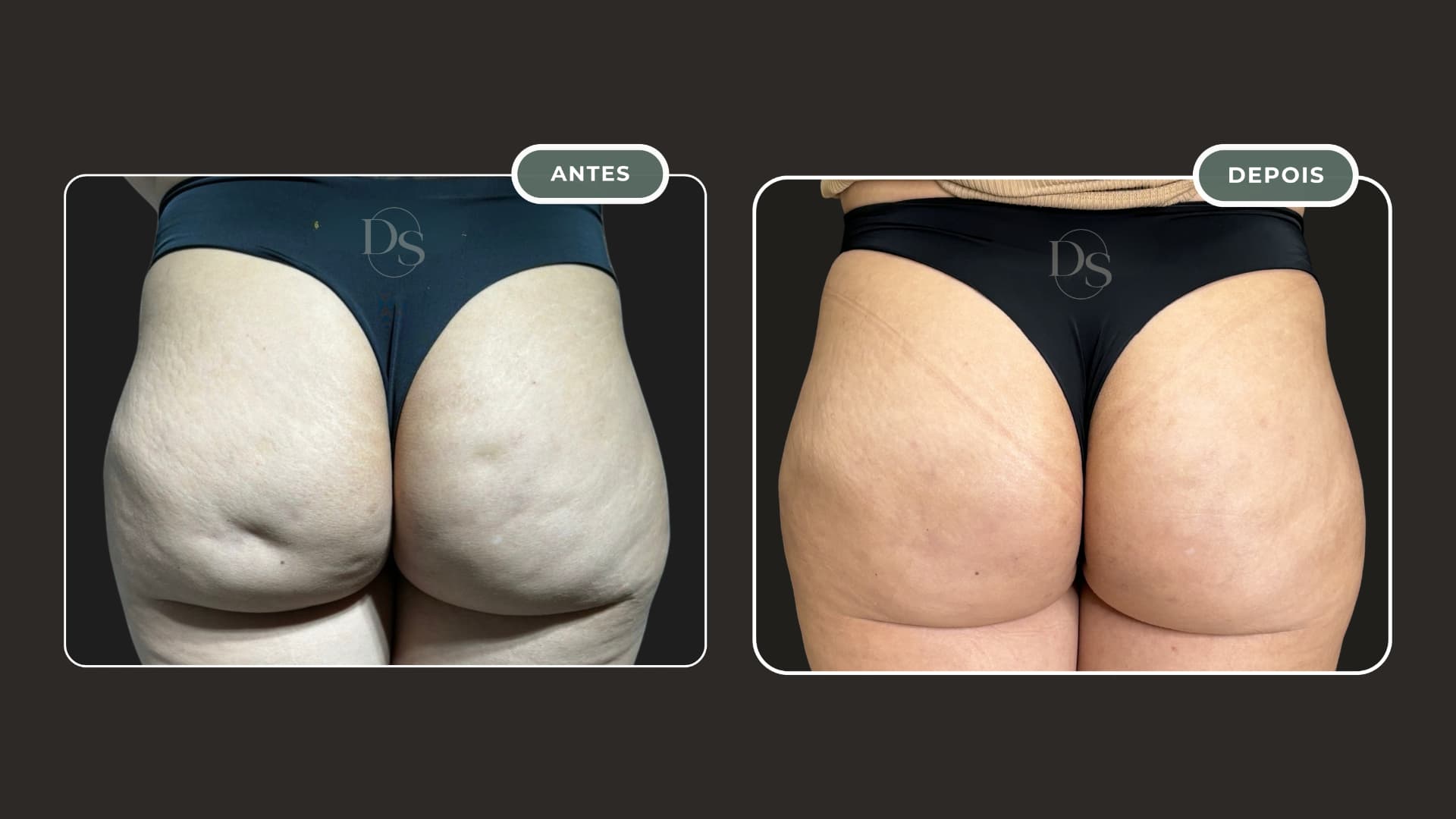 Antes e depois do tratamento de celulite — glúteos